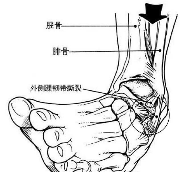 詹姆斯的高位踝关节扭伤是什么病严重吗会赛季报销吗何时能复出