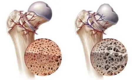 了解股骨头坏死的根源,才是有效治疗骨坏死的关键!