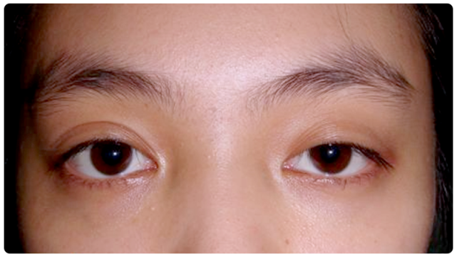 ▼右侧严重的上睑下垂