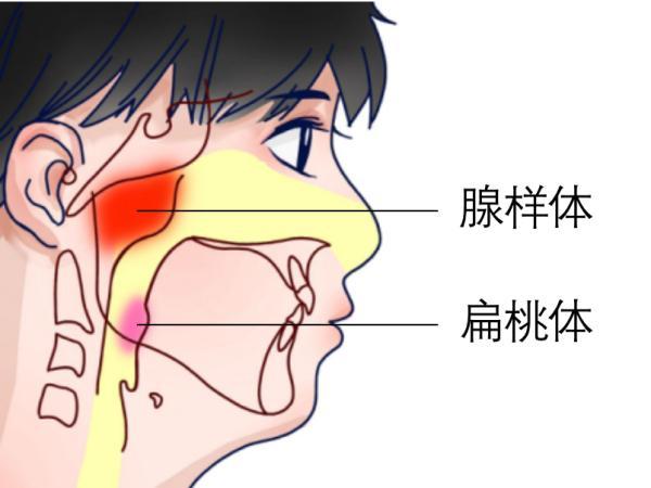 主要指腺樣體肥大和扁桃體肥大(如下圖)