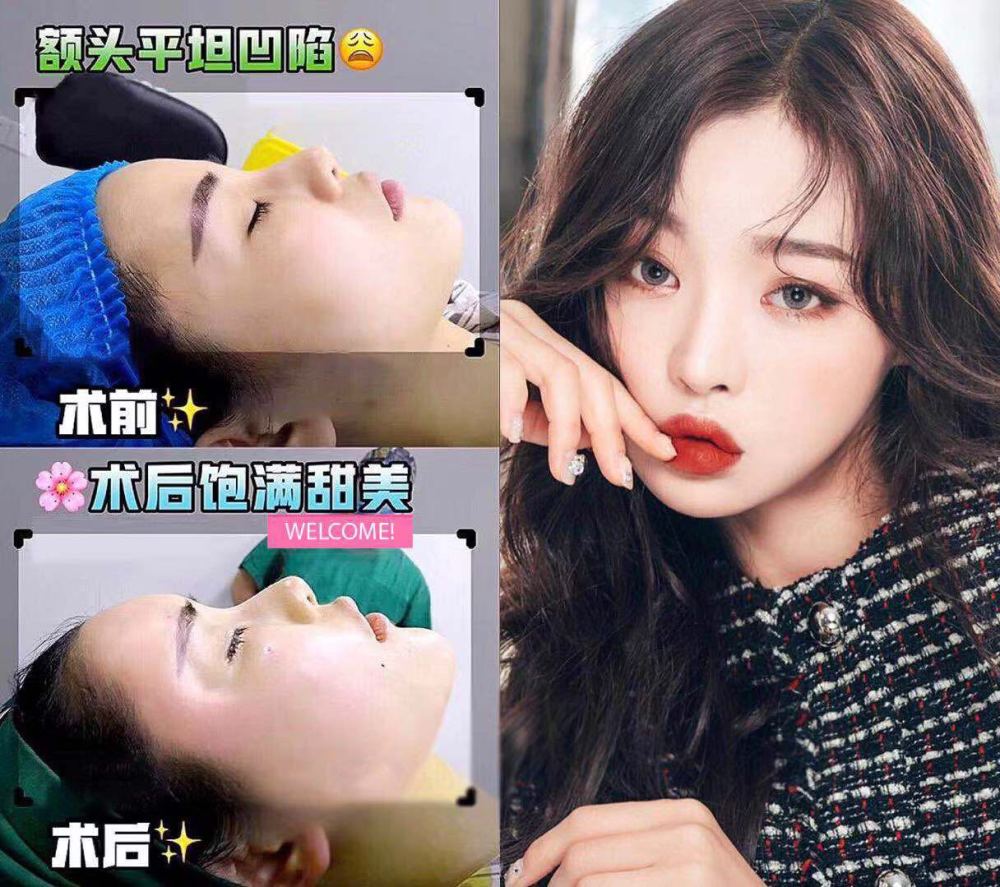 什么是自体脂肪填充,一般可以维持多长时间?