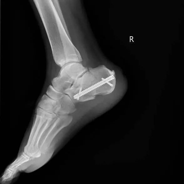 3米高坠落致右脚跟骨骨折 钉中钉固定 避免术前14天等待难题 腾讯新闻