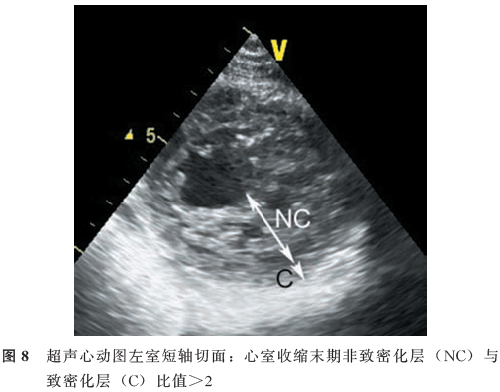 超声心动图诊断心肌病临床应用指南