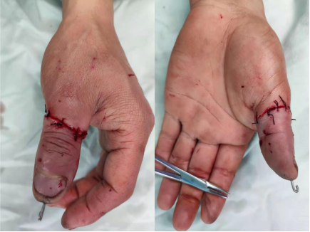 手术结束后的照片,患者指尖的金属就是克氏针