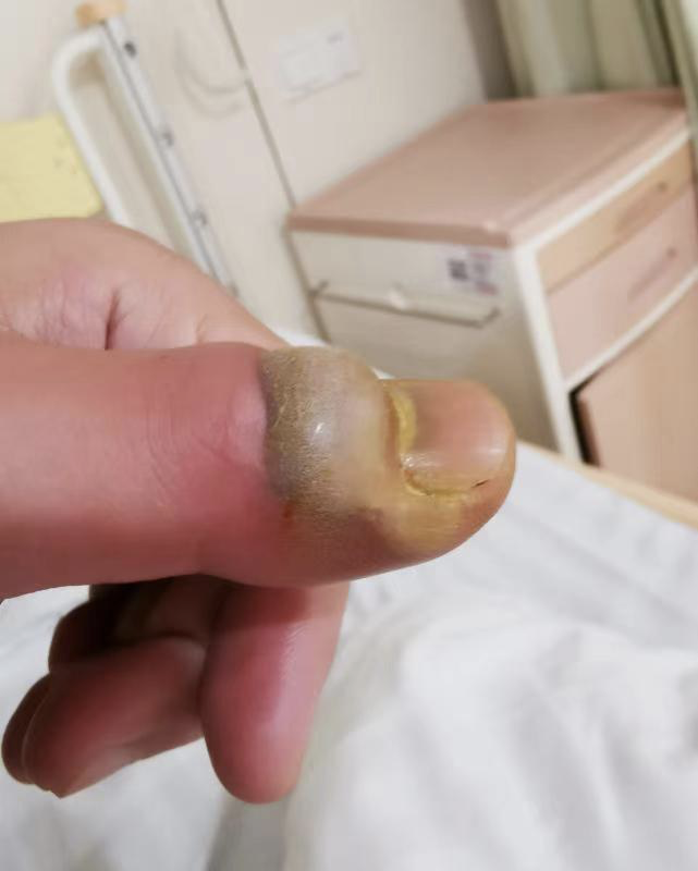 不想拔掉后手指一直有些肿痛,但是他并没在意,认为过几天就会好.