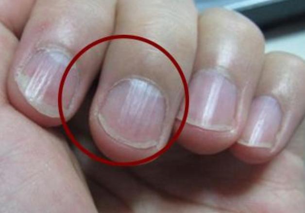 指甲上出现"竖纹",首先应该想到这5个问题,别总是瞎猜!_腾讯新闻
