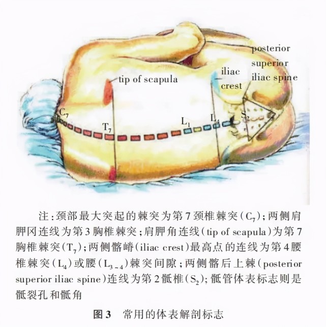 根據患者不同治療或麻醉部位要求可選取不同椎間隙如頸椎,胸椎,腰椎