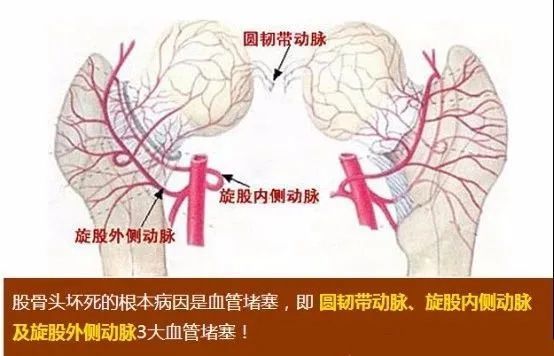 来了解,髋关节积液和股骨头坏死的关系!