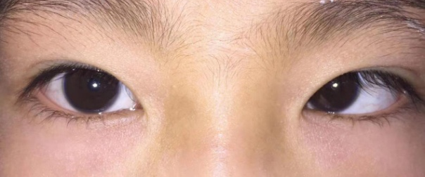 儿童斜视需要引起家长注意