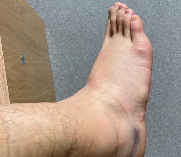 又一排球国手受伤,脚已肿成馒头状,将彻底无缘全运预赛