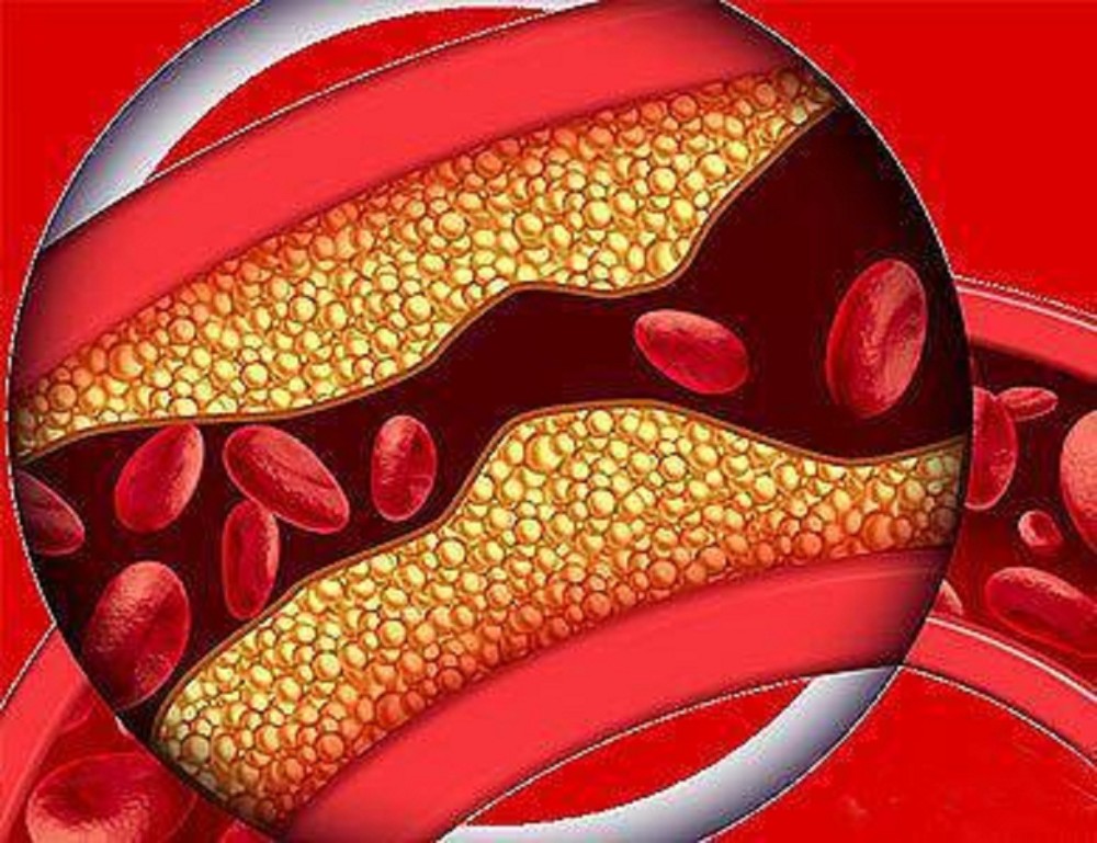 年过四十的人,有没有动脉粥样硬化?算算你的血管硬化指数是多少