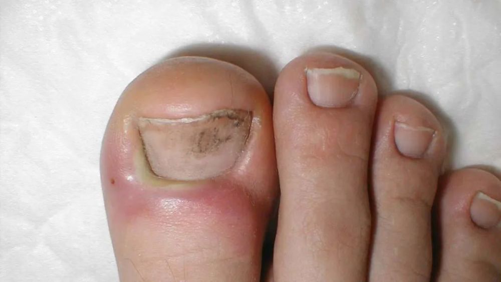 "是甲沟炎,"医生指了指我的左脚,然后看向右脚,"这只还行,不是很严重.