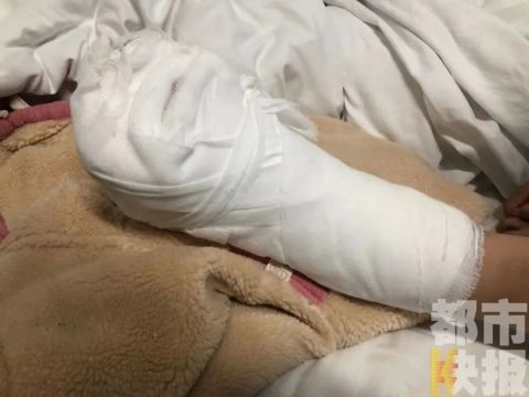 她的左脚从中间离断了,遭遇了一场让人揪心的意外,三岁小女孩曼曼一