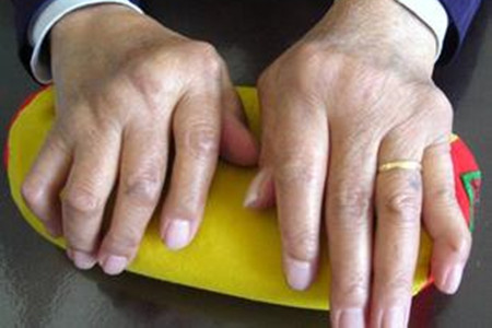 一纽扣花样畸形纽扣花样畸形又被称为纽扣指:近端指间关节因丧失主动