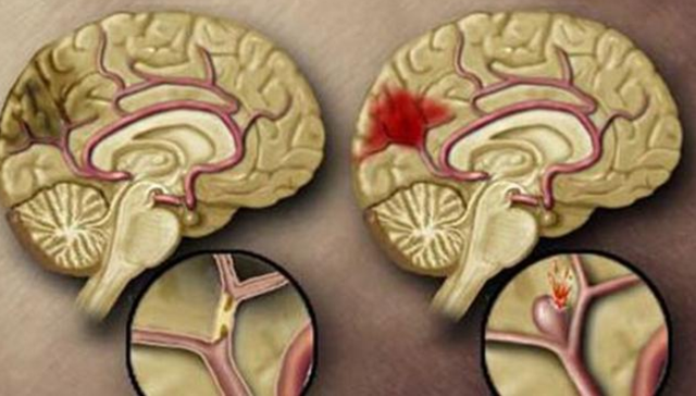 脑梗来临前身体或会发出以下信号别不当回事不妨早了解
