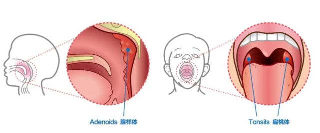 臨床上,腺樣體與扁桃體的炎性病變總是並存,若兩者同時增生肥大則使得