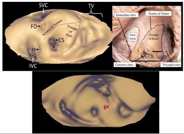 多项新技术,如器质性室速心外膜标测和消融,房颤marshall静脉酒精消融