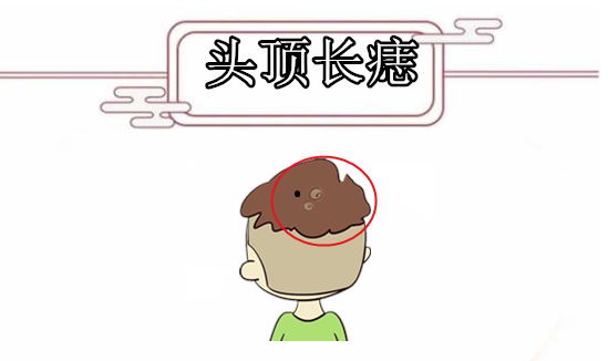 打开腾讯新闻,查看更多图片 >头顶长痣在相学当中,若是一个人的头顶的