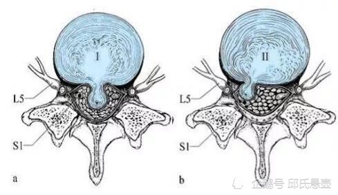 腰椎间盘突出锻炼能好吗?邱氏悬壶