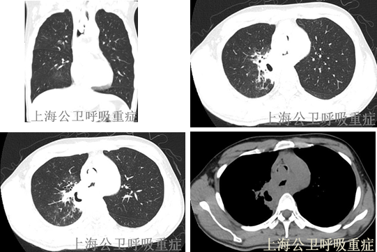 ct提示右肺上叶空洞性病变,隆突上主气管内新生物几乎完全堵塞管腔