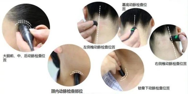 有一种检查像"头部按摩"——脑彩超了解一下