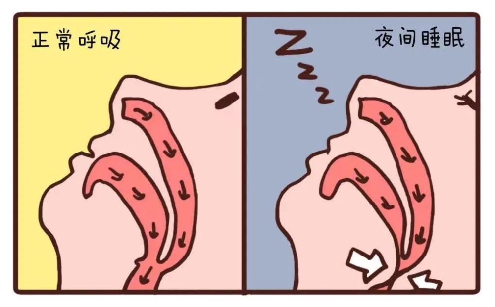 给打鼾者的"消音攻略",符合3个特征甚至可能致命