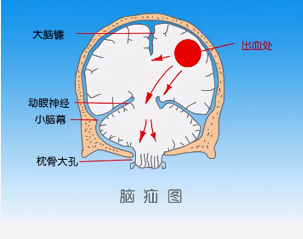 從壓力較高的分腔向壓力較低的分腔移位,造成對鄰近重要結構的壓迫,如