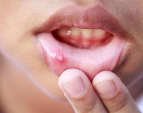 很多人都觉得口腔溃疡是一种很常见的现象,只要过几天就好,但是常见的