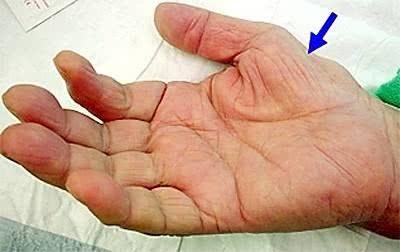 最值得人重视的,就是大鱼际部位的凹陷.