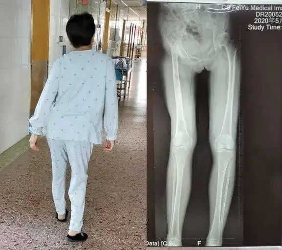 股骨头坏死长短腿应该怎么调整