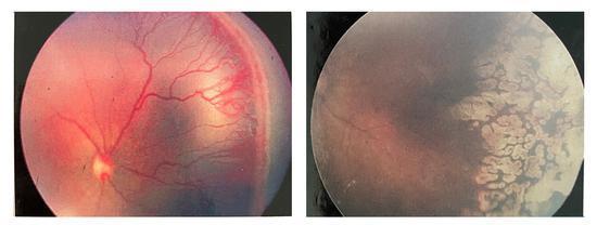 早产儿眼底视网膜病变治疗前后对比龙岗妇幼于去年 9 月引进新生儿