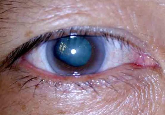 而且,青光眼也是难以治疗的,一旦涉及到眼睛的手术都是非常昂贵的