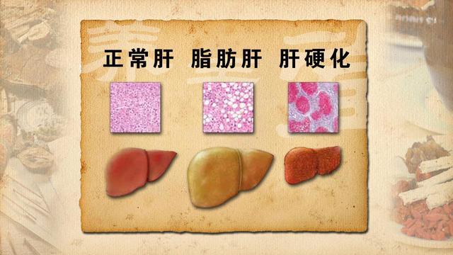 体检查出脂肪肝,我们应该怎么办?一种类型,一种调理方法