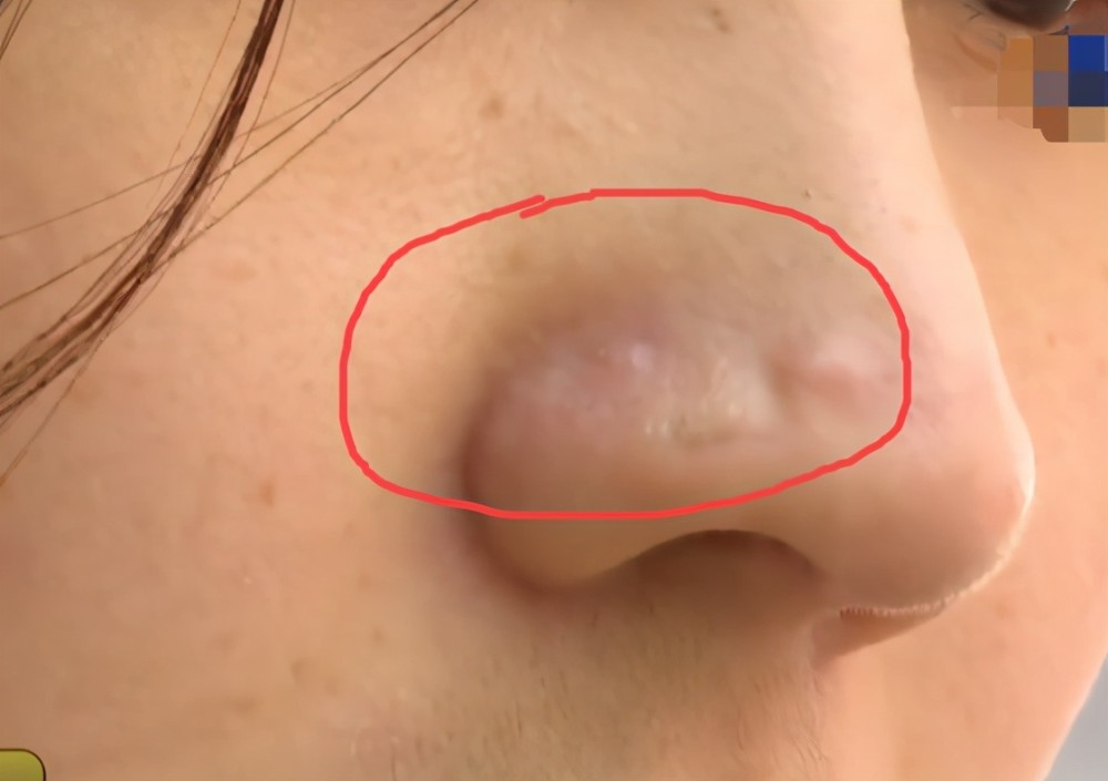 上因为手术留下了一条很清晰的疤痕,一开始做手术想要修复的增生痘