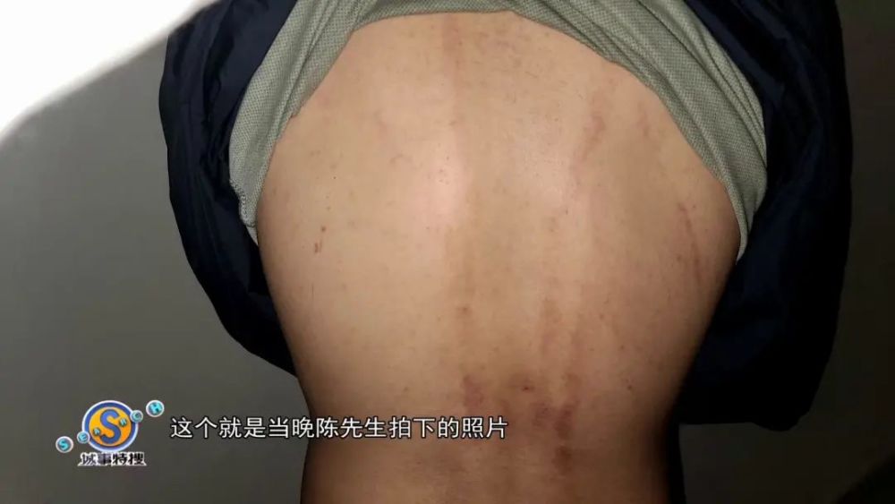 两男子结伴干这事半夜背部刺痛难忍全是伤痕医生一句话亮了