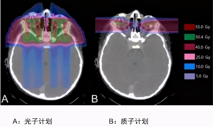 這是視網膜母細胞瘤兩種療法劑量分佈圖比較,很清楚地看到質子治療