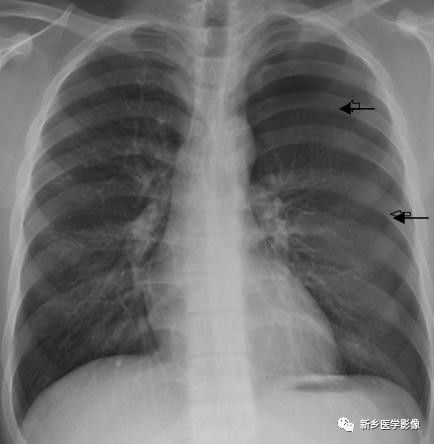 胸膜5大基本病变 必须掌握的医学影像基础 Qtc Care