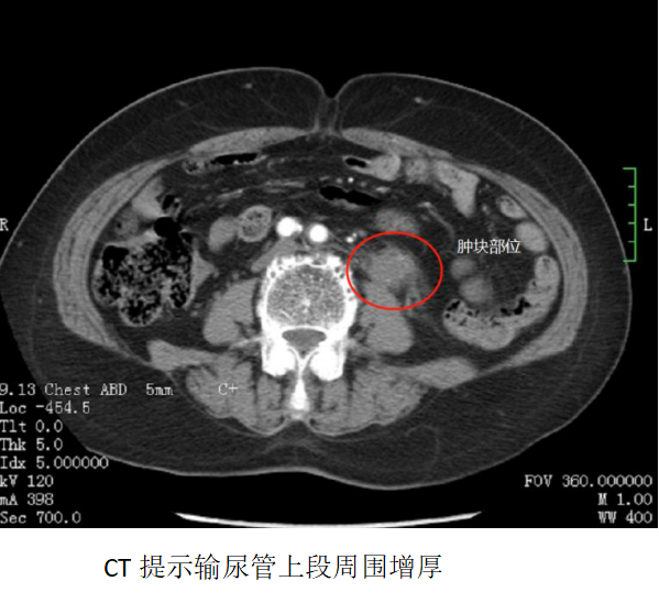 六旬奶奶腰痛月餘以為是結石沒想到竟是輸尿管癌