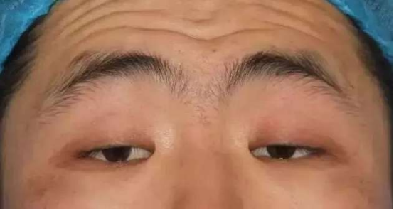 上睑下垂矫正与重睑术有什么区别 丨科普篇 腾讯新闻