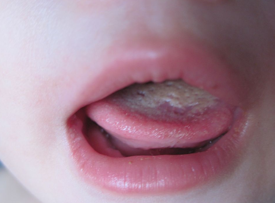 吃一次毒晚餐等同吃5个塑料袋6岁男孩积食拖成疳积不长个