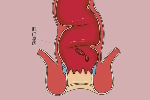 從肛門裡出來一塊肉是不是患上了痔瘡