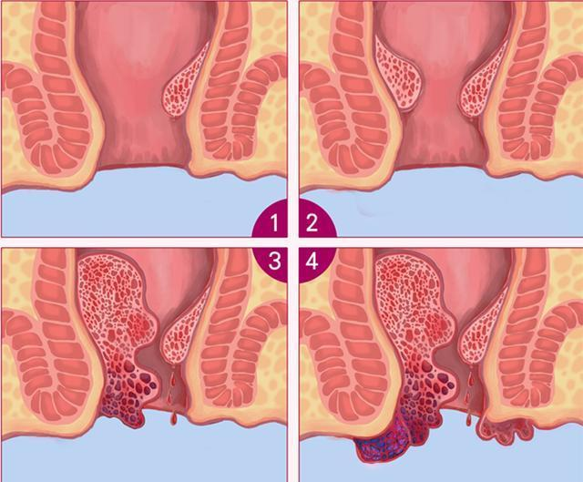 还有一种就是肛垫下移学说,认为痔原本是肛管部位正常的解剖结构,是