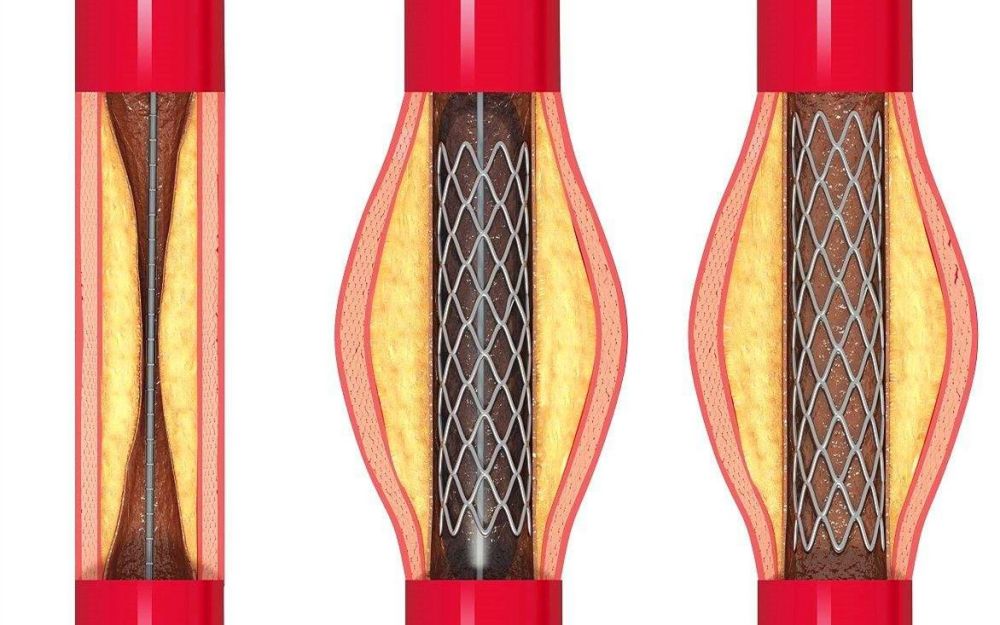 心脏支架球囊卖出了白菜价专家提醒当心4个弊端