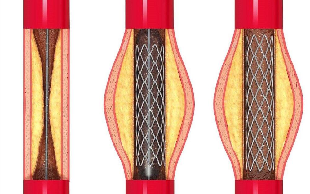 心脏球囊和支架的区别图片