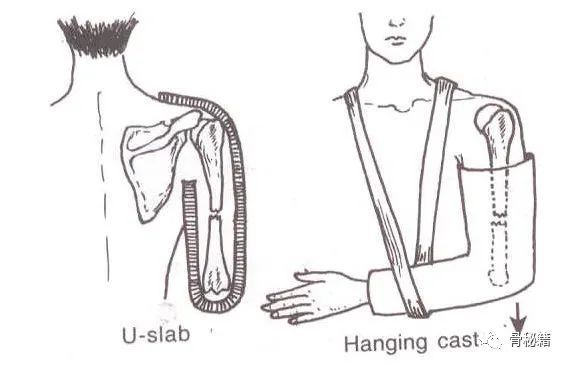 骨科精选一文讲透骨科医生看家本领石膏固定