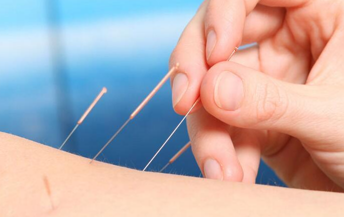 董氏奇穴放血疗法大全(纯干货)_腾讯新闻