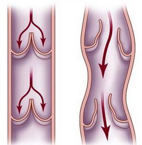 避免下肢静脉曲张发生要注意哪些方面预防