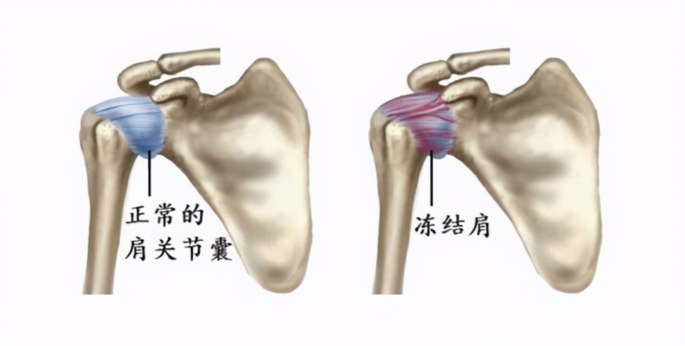 但没有哪个学说能被人完全接受和解释所有临床现象,所以,目前冻结肩的