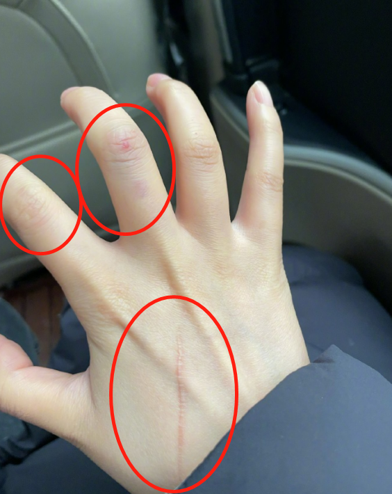 徐冬冬拍视频意外受伤!手部破皮淤青明显,嫩白皮肤上一条长伤疤