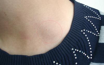 身体出现4个异象可能就是艾滋病的警报千万别大意